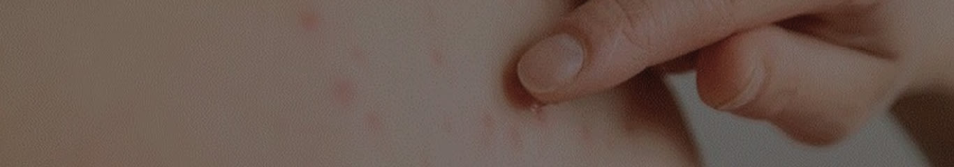 image - Magazine | Impariamo a conoscere la Scarlattina