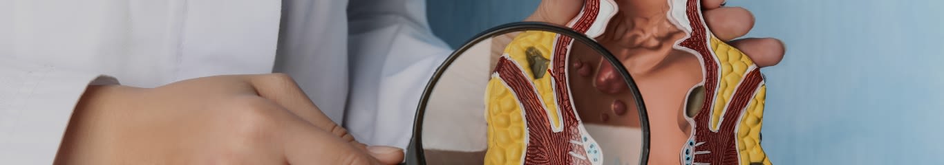 Emorroidi Interne: Sintomi, Rimedi Naturali e Cura