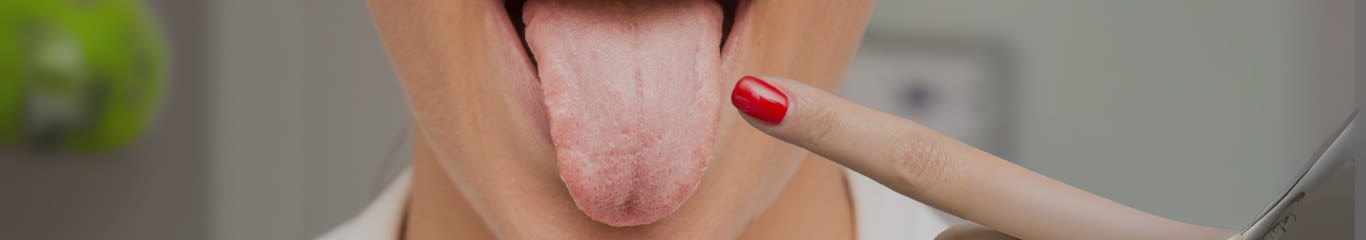 Candida Orale: un fastidio comune, soprattutto nei neonati