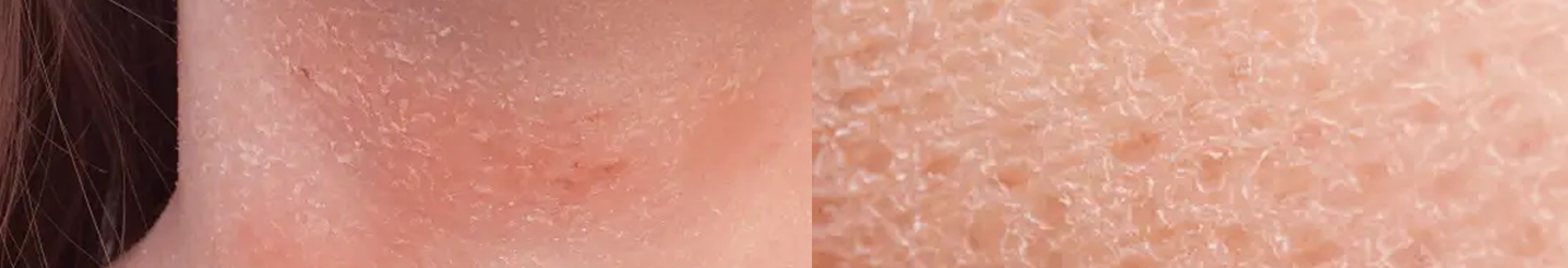 hero desk - Avene - Pelle secca atopica