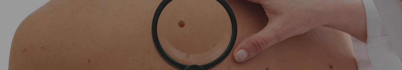 image - Magazine | Come proteggere i nei al sole