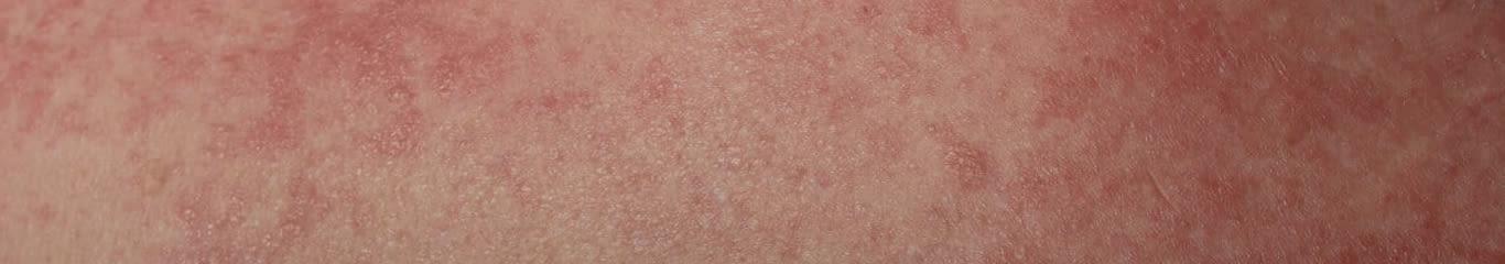 Dermatite da stress: cause e rimedi