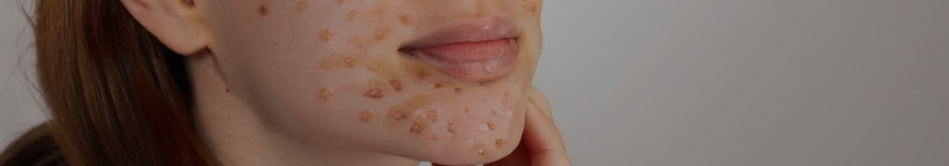 image - FAQ: L'acne dipende dall'età? Scopri perché anche la pelle matura può soffrirne
