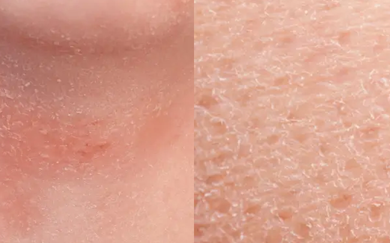 hero mobile - Avene - Pelle secca atopica