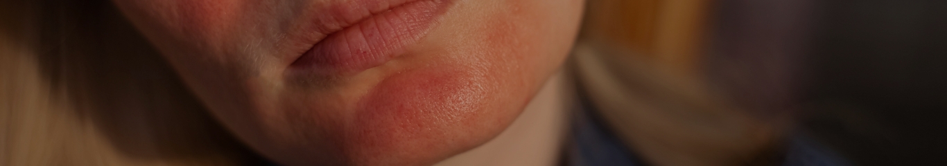 image - Skincare per rosacea: guida completa per lenire e proteggere la pelle sensibile