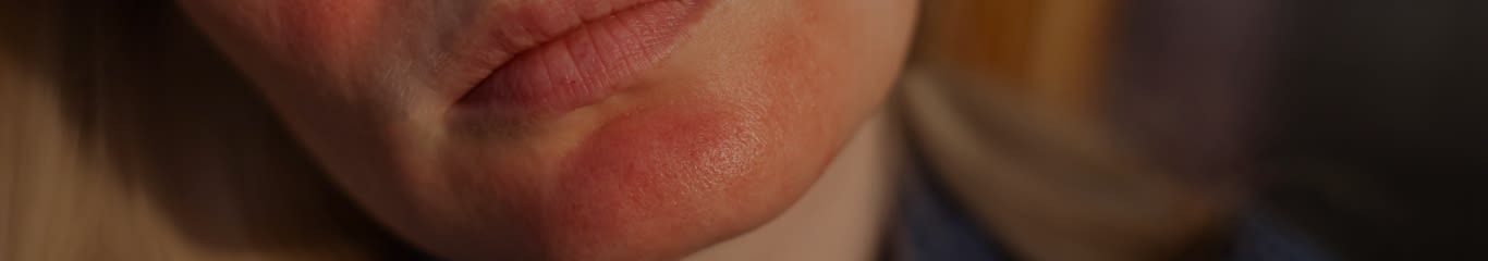 image - Skincare per rosacea: guida completa per lenire e proteggere la pelle sensibile