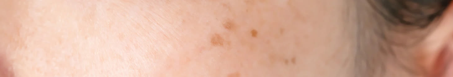 Hero desk - Macchie e Cicatrici - Rilastil