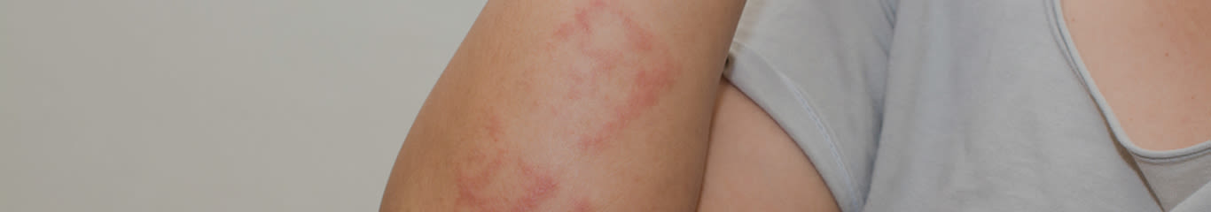 Allergie della pelle: consigli utili