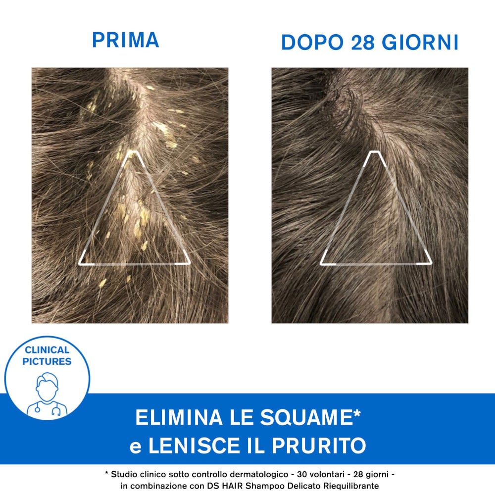 image - 984837599 - URIAGE DS HAIR SHAMPOO CHERATORIDUTTORE 150 ML - 4741411_8.jpg