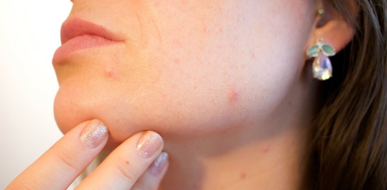 Magazine | Acne cause sintomi e rimedi