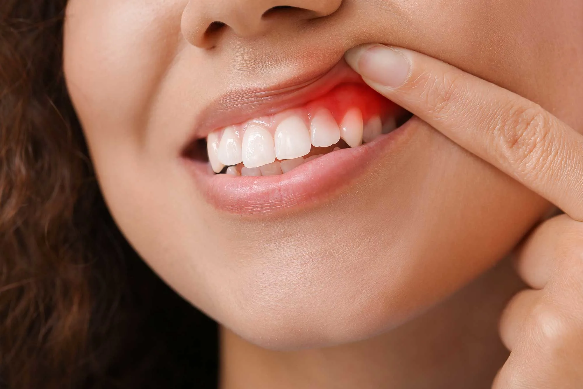 Image - Gingivitis versus parodontitis: Wat is het verschil?
