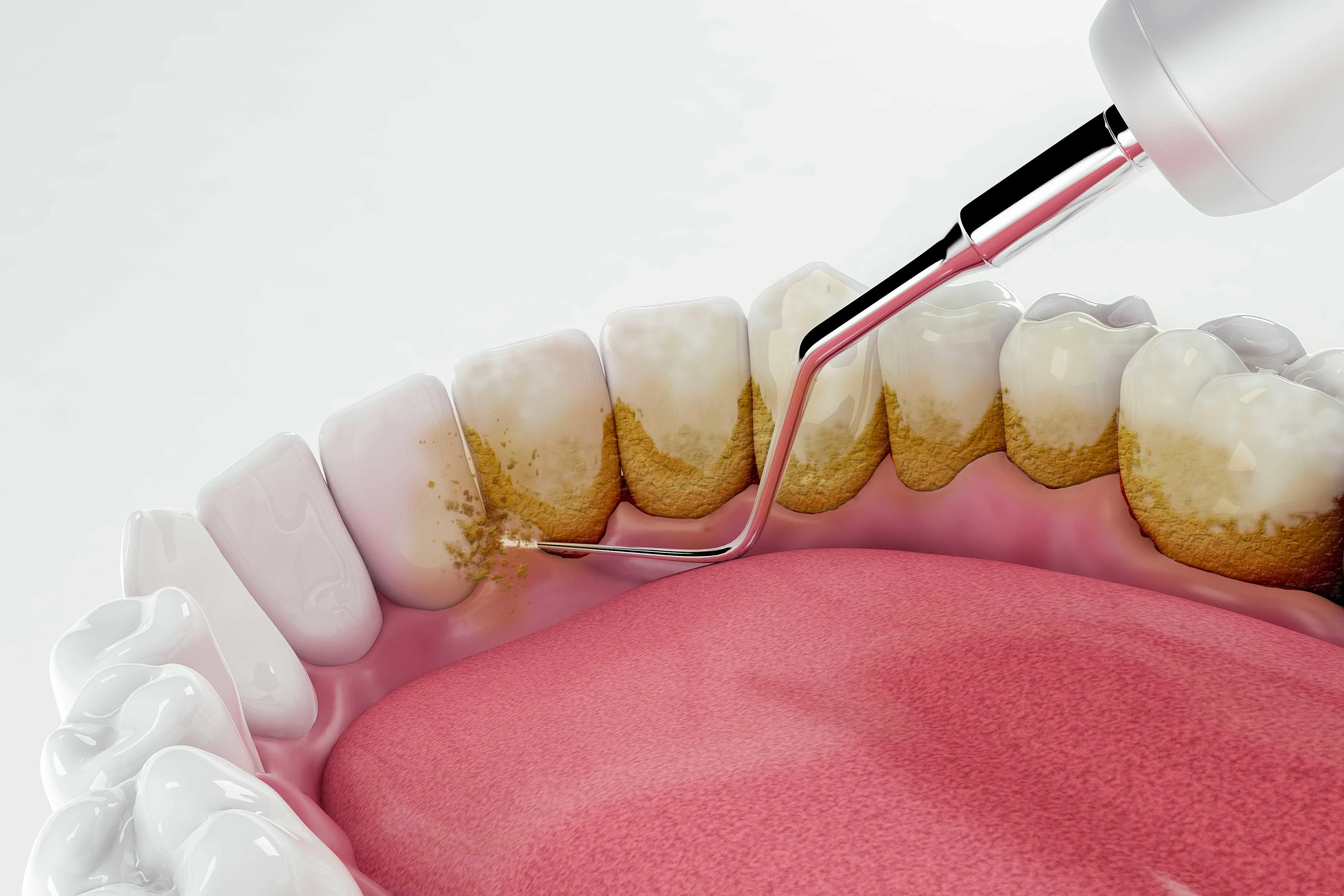 Article - Tartar (Dental Tartar or Dental Calculus): Causes, Symptoms, and Removal - Tandsteen (tandsteen of tandcalculus): Oorzaken, symptomen en verwijdering - HERO