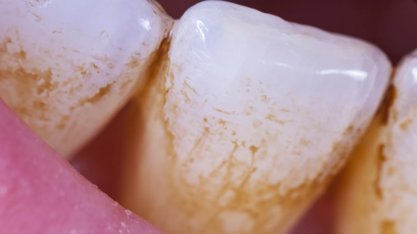 Teeth covered in plaque