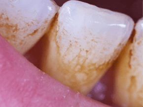 Teeth covered in plaque