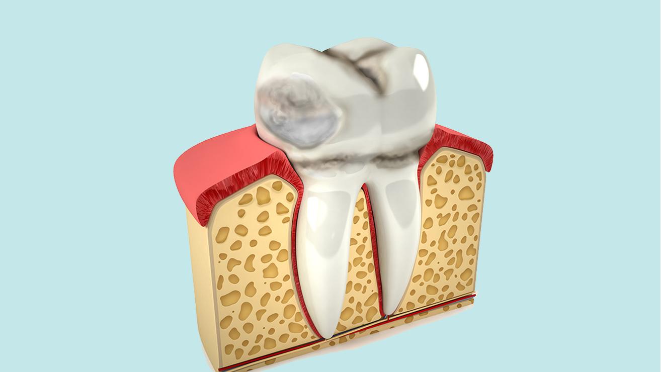 Dents on Teeth