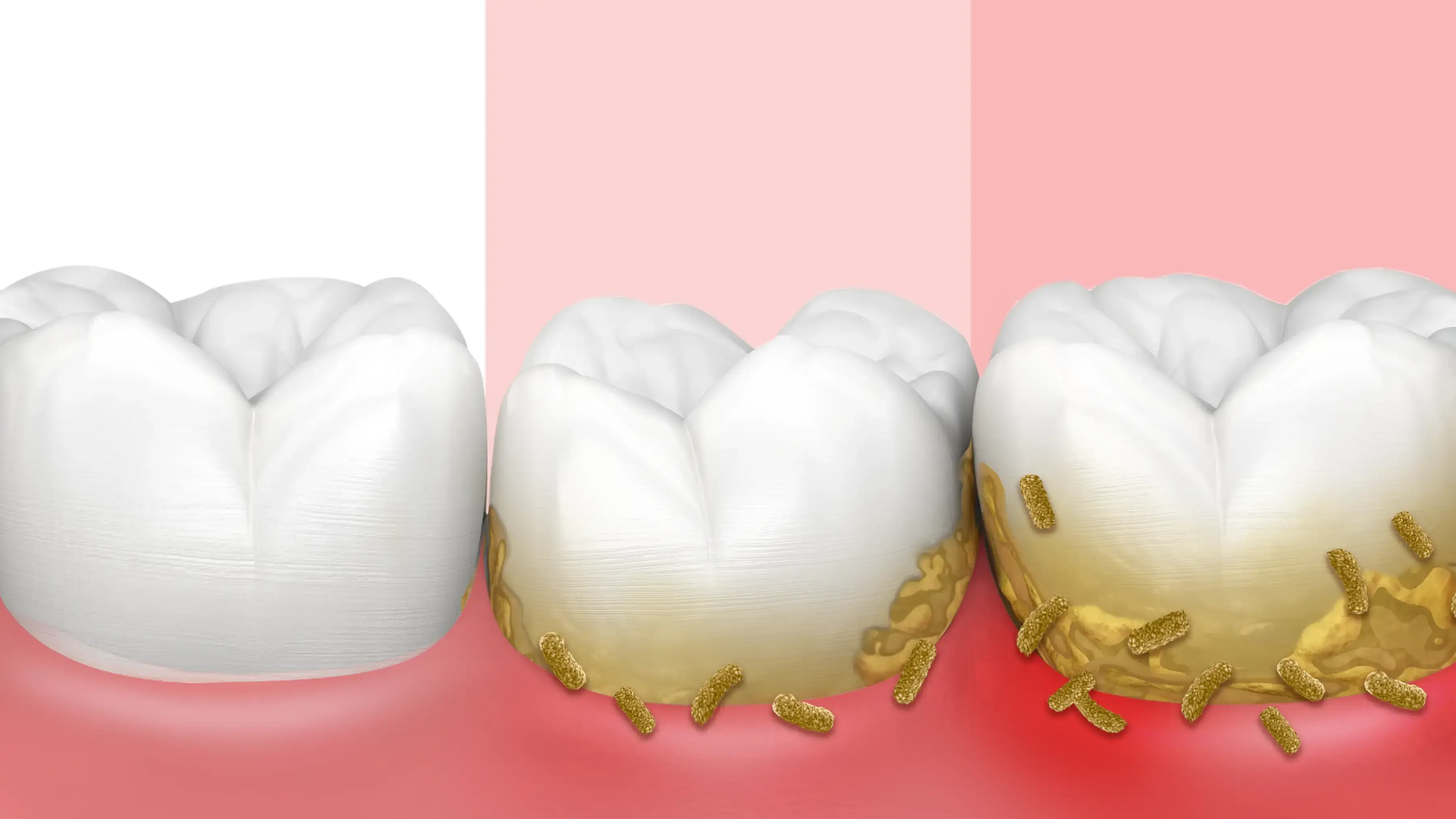 Stages of gum inflammation