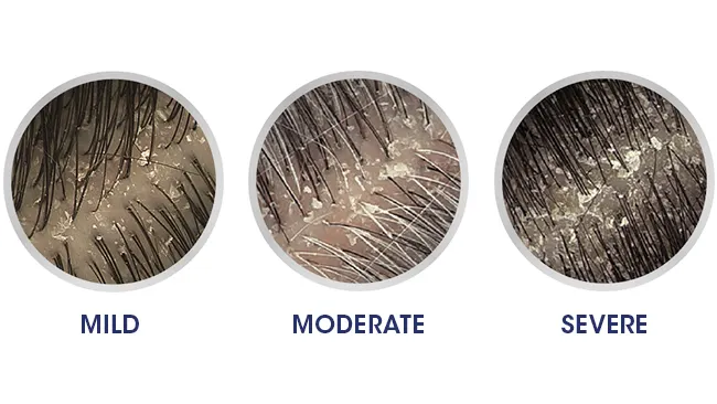 Severe Dandruff types - Head & Shoulders