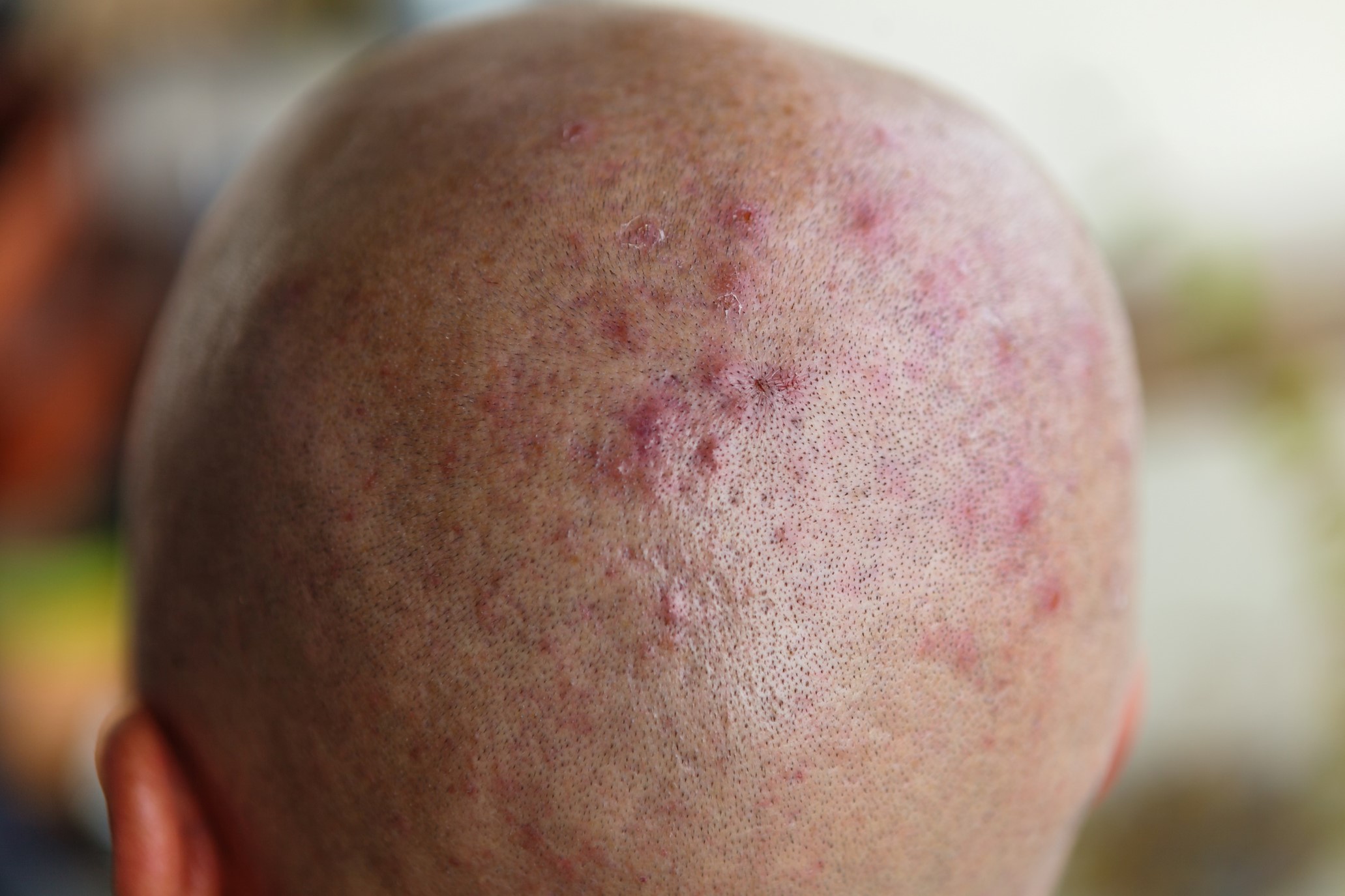how-to-treat-acne-prone-scalp