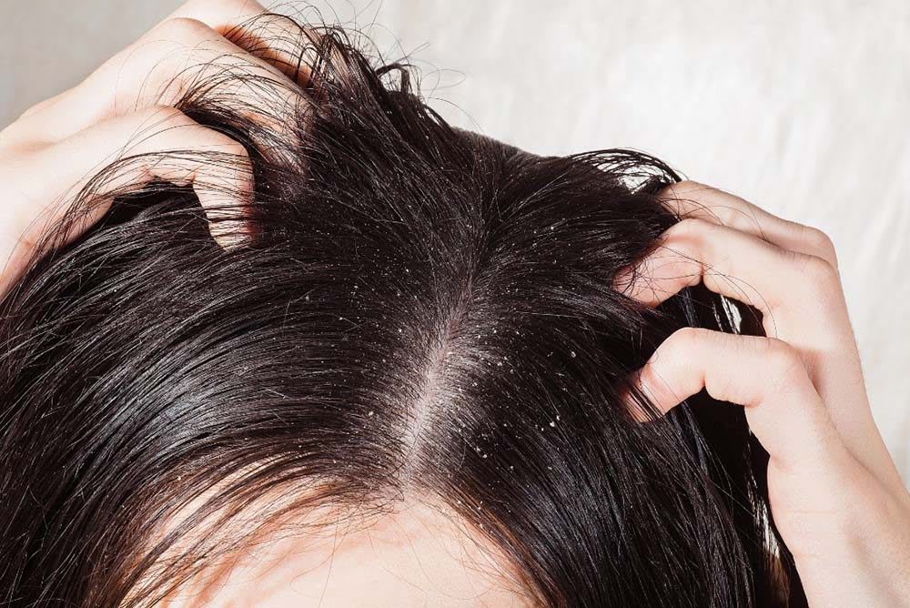 Dandruff On Scalp