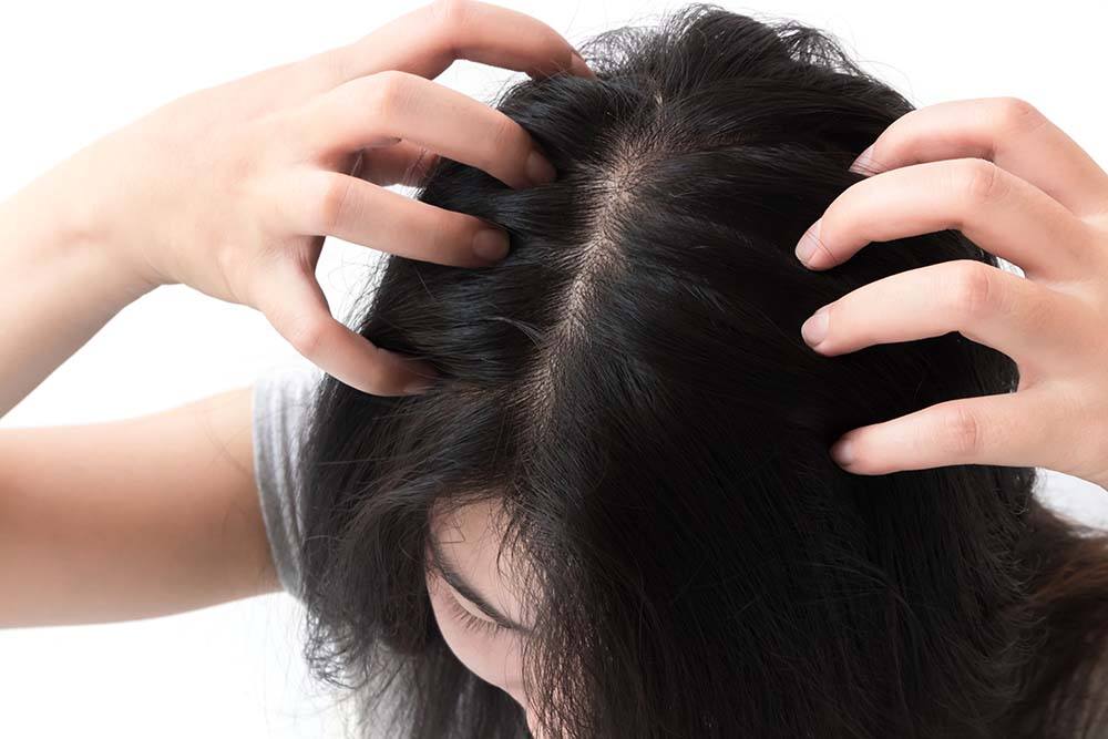 causes-of-dandruff