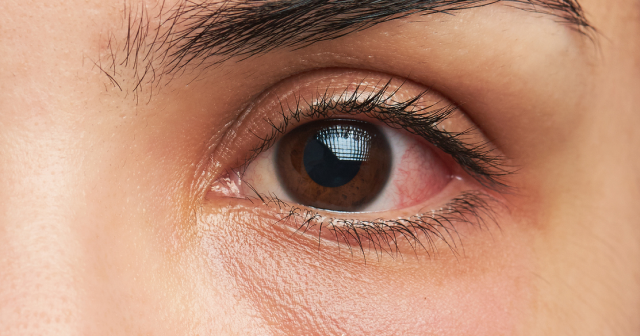 Carotid cavernous fistula symptoms include bulging red eyes