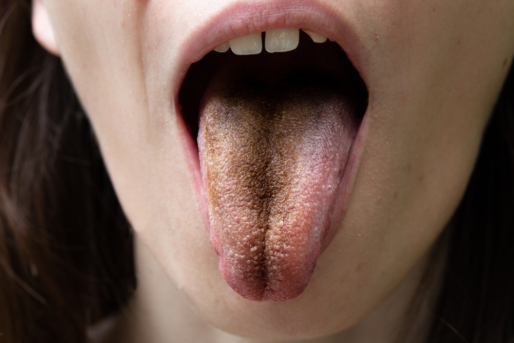 Image of a black hairy tongue