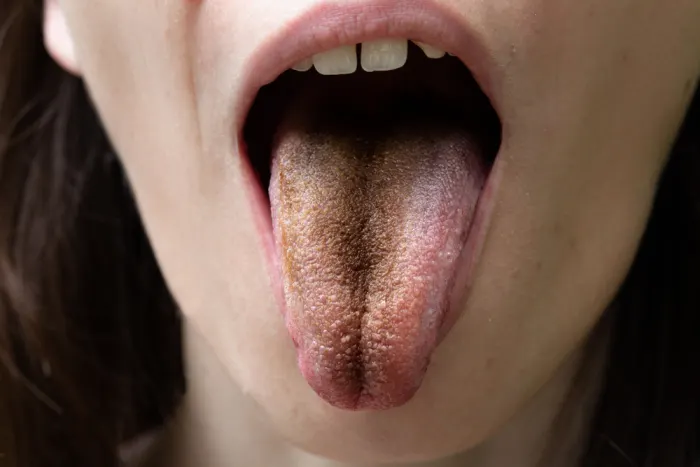 4 common tongue problems: Treatment and when to worry
