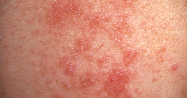 Red And White Spots On Skin Heat Rash Prickly Heat Miliaria 