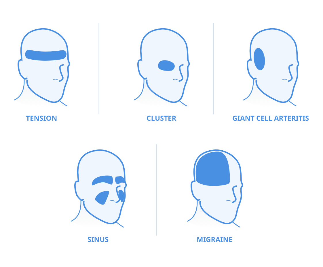 Images Types Of Headache Illustration Headache Pain Locations 