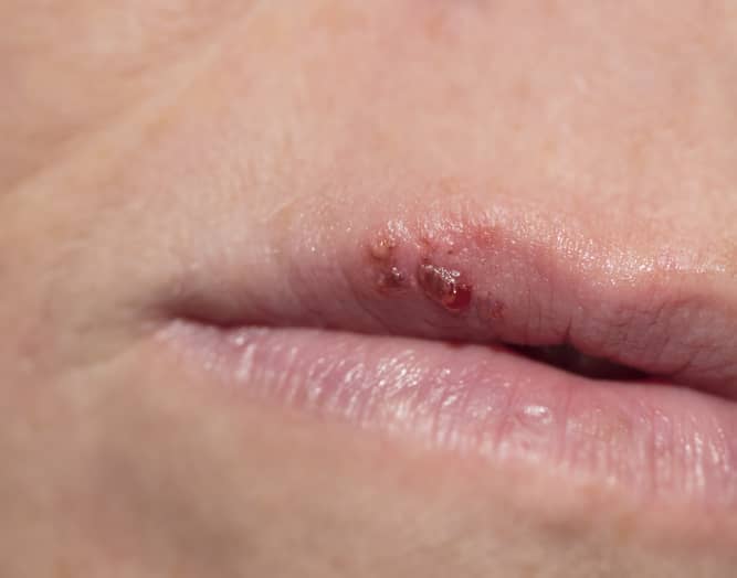 Close up of lips with a cold sore