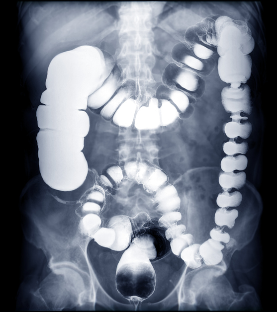 Barium enema Healthily