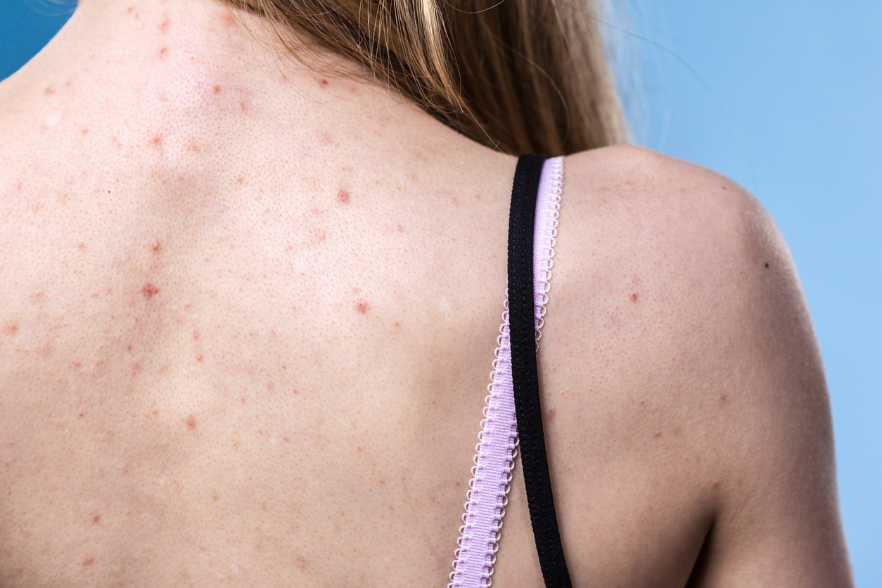 Young woman with adult acne on back