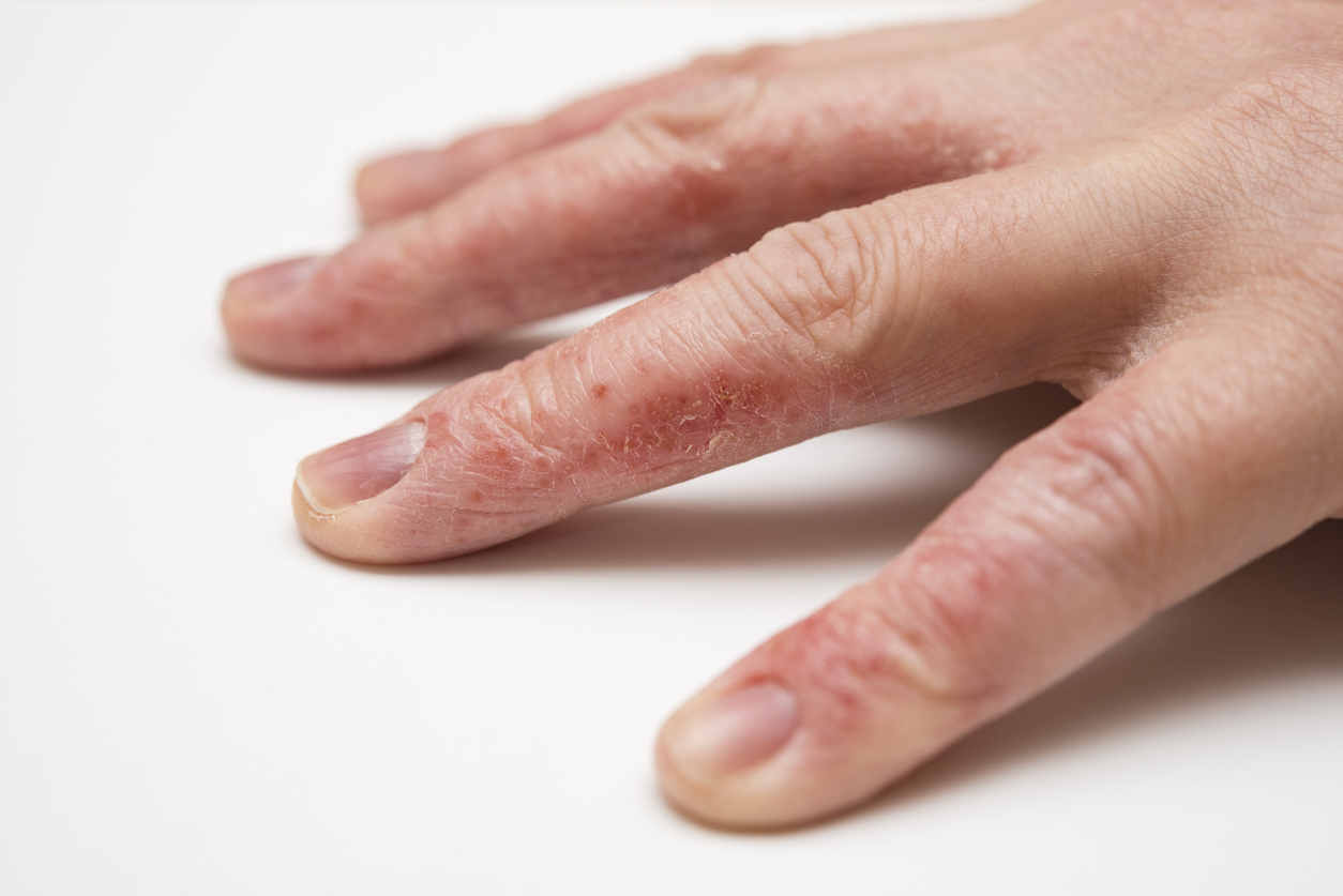 Eczema on hands