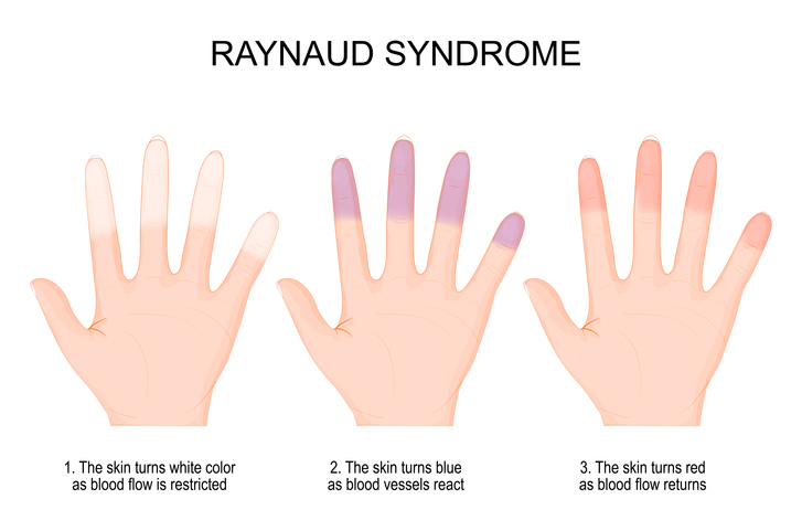 Raynauds Syndrome