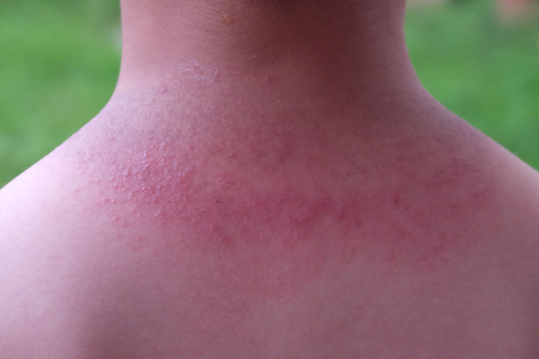 Heat rash on back of neck
