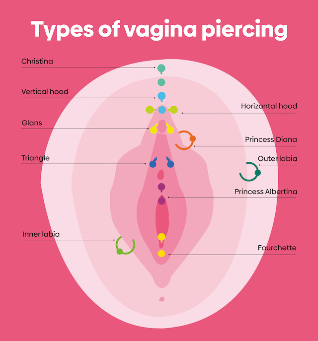 阴道图显示的类型阴道穿刺