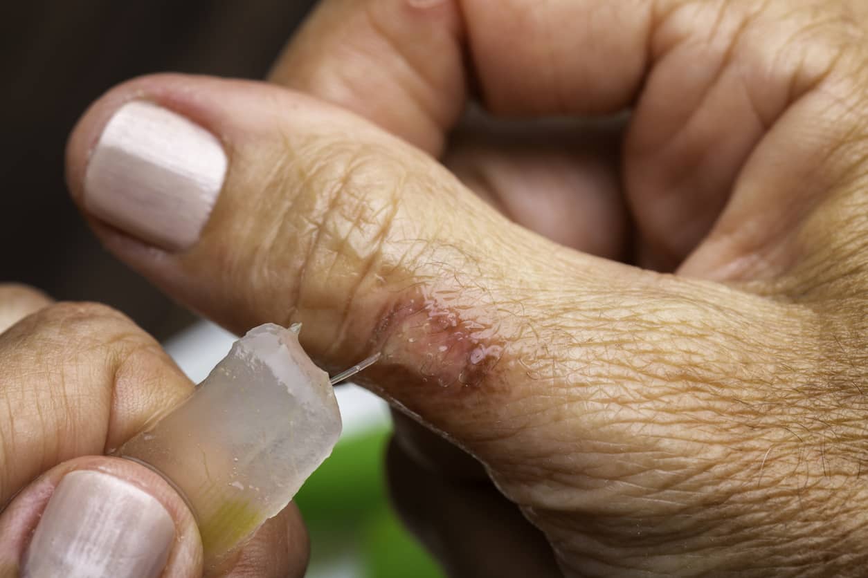 Second degree burn on woman hand finger with aloe vera gel treatment for pain relief