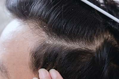 How To Get Rid Of Dandruff Your Md