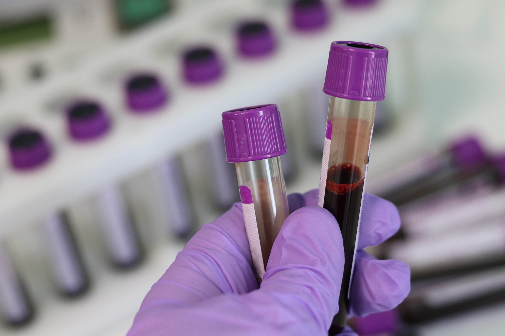 Haemoglobin blood test: What to expect