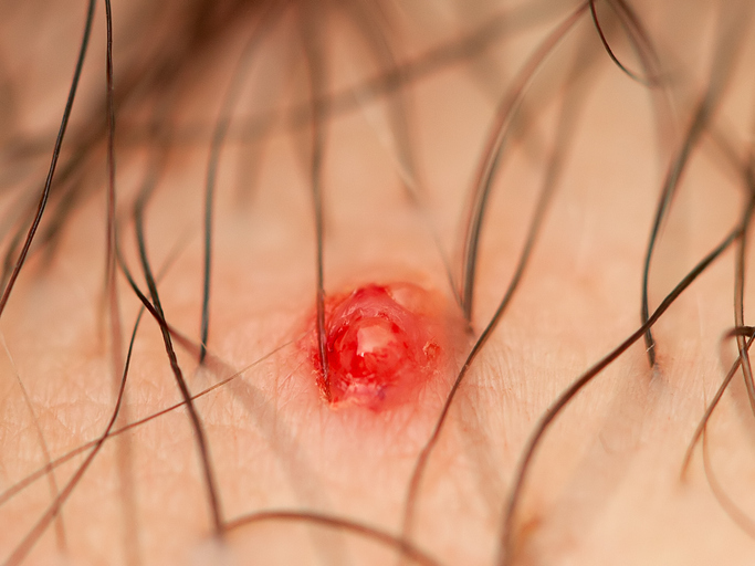 Close up of infected skin, skin abscess concept