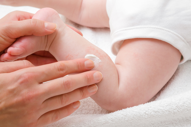 Parent applying cream to eczema on baby leg