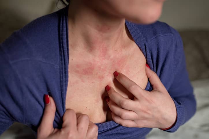 Person in blue jumper itching rash on chest