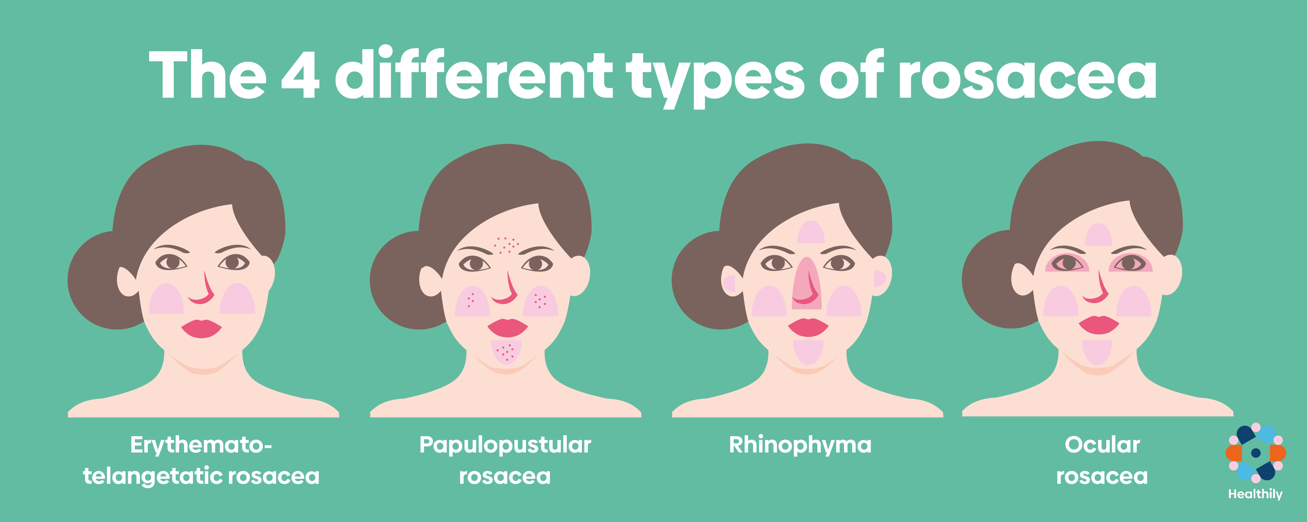 Types of rosacea