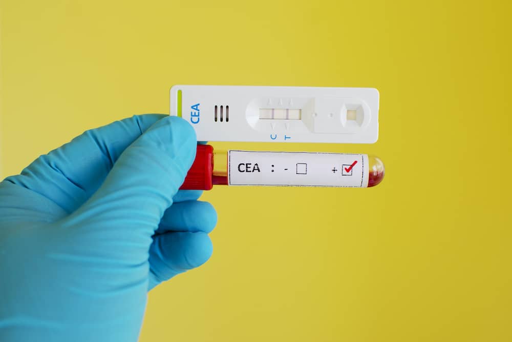 CEA (Carcinoembryonic antigen) test