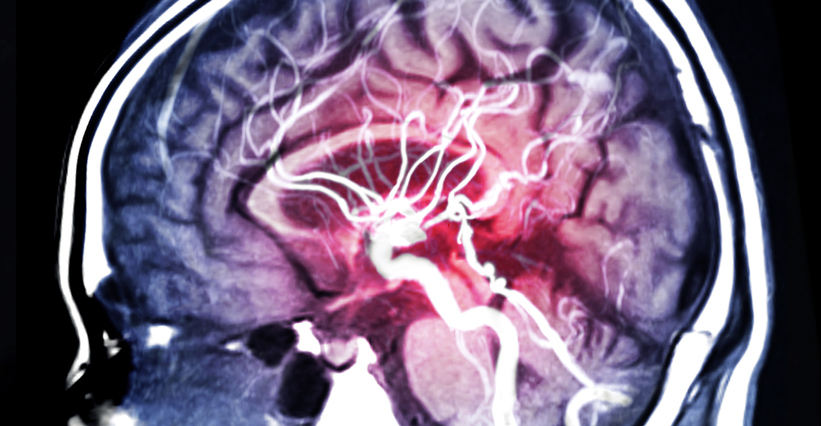 MRA Brain scan, brain aneurysm