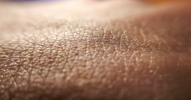 Human skin up-close to represent cutaneous anthrax
