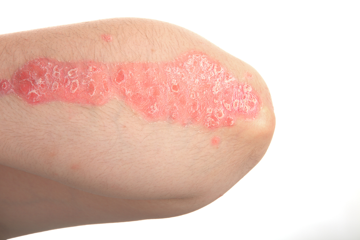 Psoriasis Vs Eczema 