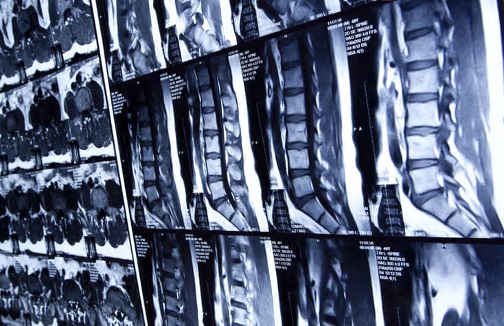 What is spinal cord compression?