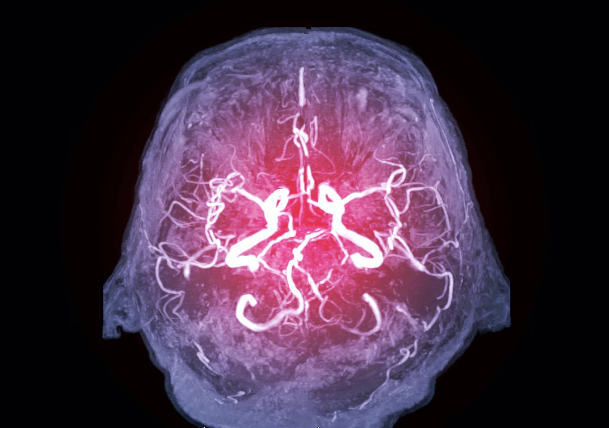 Magnetic resonance image (MRI) of Vessel in the brain axial view or MRA brain.
