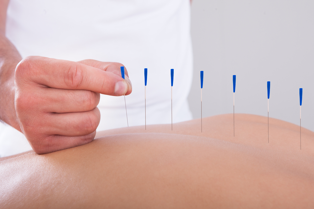 woman-having-acupuncture-therapy